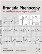 Brugada Phenocopy: The Art of Recognizing the Brugada ECG Pattern