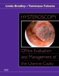 Hysteroscopy: office evaluation and management of the uterine cavity