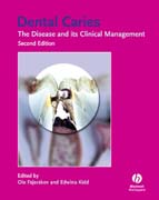 Dental caries: the disease and its clinical management
