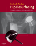 Hip resurfacing: principles, indications, technique and results