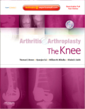 Arthritis and arthroplasty: the knee