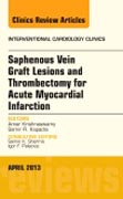 Saphenous Vein Graft Lesions and Thrombectomy for Acute Myocardial Infarction, An Issue of Interventional Cardiology Cli