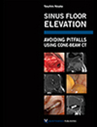 Sinus Floor Elevation: Avoiding Pitfalls Using Cone-Beam CT