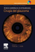 Cirugía del glaucoma