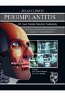 Atlas clínico: Periimplantitis