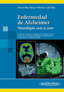 Enfermedad de Alzheimer: neurología caso a caso
